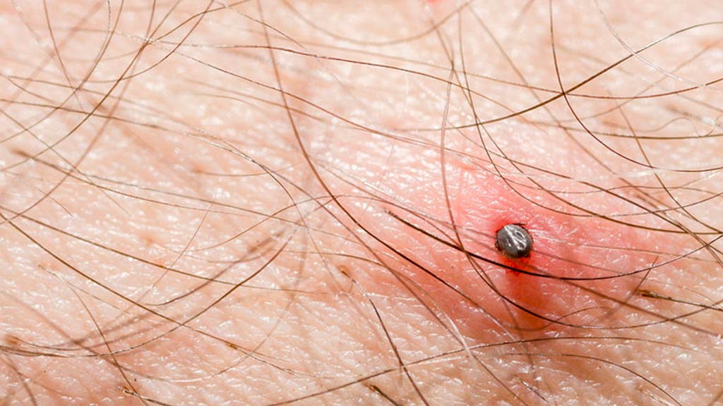 Dr. Howard Gittelman Diagnosed with Lyme Disease